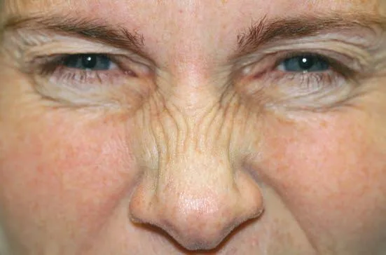 Fig 6. Dynamic bunny lines: radial creases fanning across the nasal dorsum and sidewalls on active nasalis contraction, the treatment target for lateral-wall toxin.