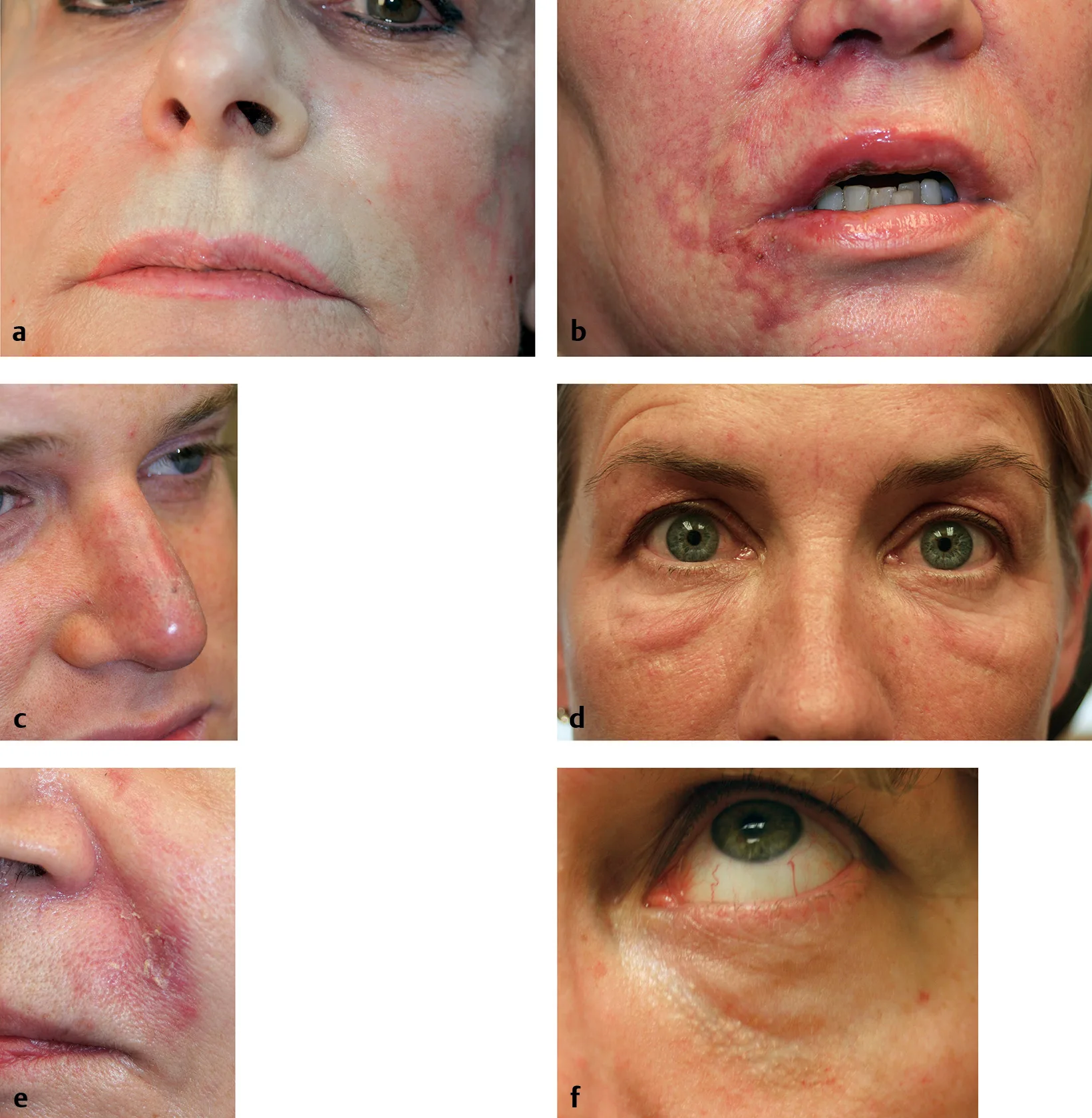 Fig 7. Clinical spectrum after facial filler: (a) acute blanching of vascular occlusion, (b) purpura after facial-artery occlusion, (c) vascular injury from non-surgical rhinoplasty in a post-operative nose, (d) delayed hypersensitivity, (e) herpetic outbreak, (f) Tyndall on the lower eyelid.