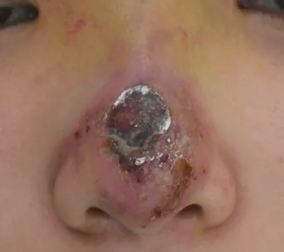 Fig 8. Localised skin necrosis of the nasal tip after filler: central black eschar surrounded by violaceous, congested skin in the lateral-nasal/columellar territory.