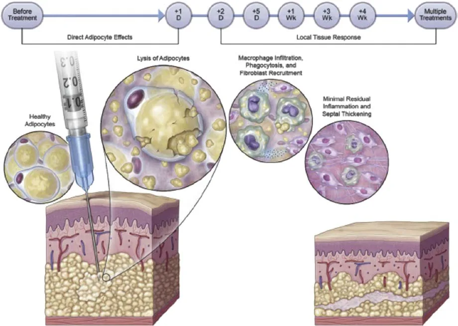 Fig 2. Mecanismo y curso temporal del ácido desoxicólico: adipocitos sanos → lisis de adipocitos (efecto directo, día 1–2) → infiltración macrofágica, fagocitosis y reclutamiento de fibroblastos → inflamación residual mínima con engrosamiento septal (respuesta tisular local a lo largo de semanas), a través de múltiples tratamientos.