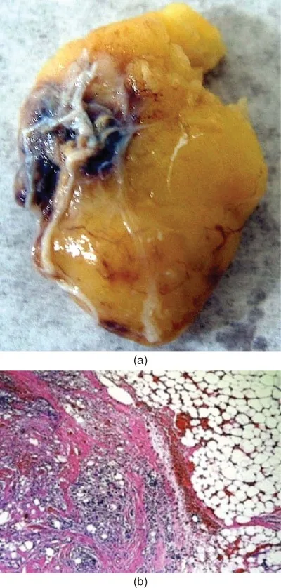Fig 3. Tejido adiposo extirpado dos días tras la inyección de desoxicolato sódico: (a) pieza macroscópica con una zona hemorrágica/necrótica en el punto de inyección; (b) H&E que muestra un denso infiltrado inflamatorio adyacente a adipocitos preservados.