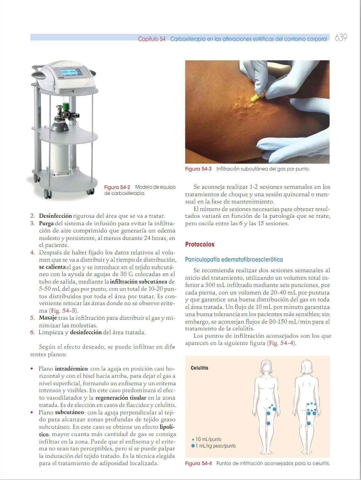 Fig 8. Carboxiterapia en el remodelado corporal: un dispositivo de CO₂ con flujo regulado; infiltración de gas subcutánea por punto con una aguja fina; y los puntos de infiltración recomendados para la celulitis — con el protocolo de texto de 5–50 mL/punto, 10–20 puntos, flujo 10 mL/min.