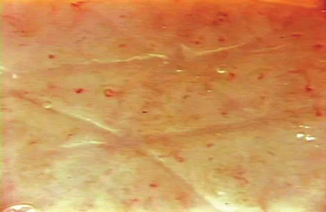 Fig 9. Capilaroscopia de piel tratada con CO₂ subcutáneo: aumento del número de capilares dérmicos tras la carboxiterapia, ilustrando su mecanismo vascular (no primariamente adipocitolítico).