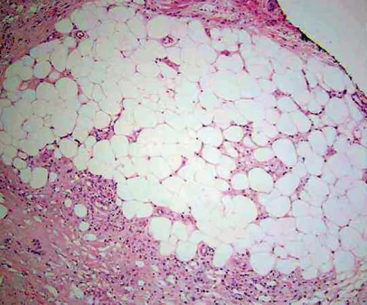 Fig 4. Grasa subcutánea humana aproximadamente una semana tras la inyección de desoxicolato: una banda de infiltrado inflamatorio en el margen inferior del lobulillo adipocitario, con adipocitos lisados e intactos.