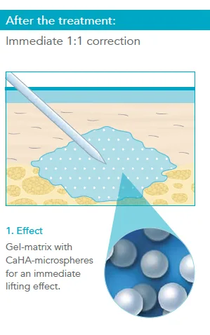 Fig 1. CaHA dual mechanism, effect 1 — immediate correction: the gel matrix carrying CaHA microspheres provides a 1:1 lifting effect the day of injection.