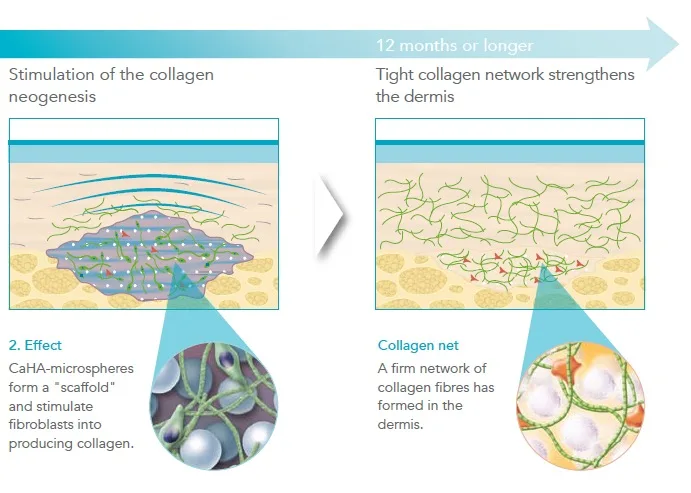 Fig 2. CaHA dual mechanism, effect 2 — over 12 months or longer the microsphere scaffold stimulates fibroblasts, and a firm collagen network forms in the dermis.