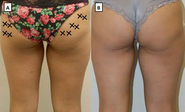 Fig 3. Non-surgical gluteal/hip recontouring with body PLLA: (A) baseline with the lateral/hip-dip injection zones marked with X, (B) after one treatment showing filled lateral depression and smoother contour.