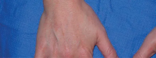 Fig 5. Dorsal hand after CaHA subcutaneous volumisation: softened tendon and vein relief with preserved natural contour.