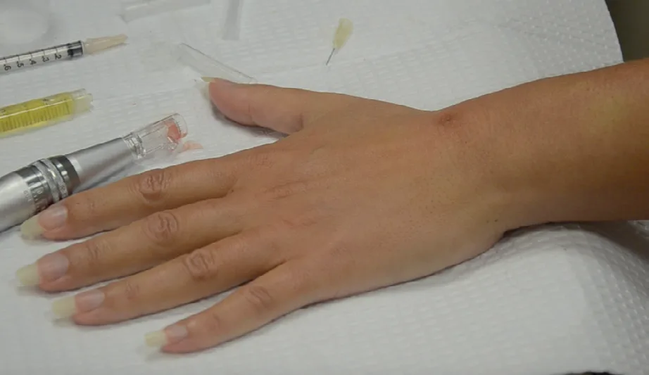 Fig 4. Dorsal-hand rejuvenation setup: the hand rests on the field with the filler syringes and injector; the working plane is the superficial subcutis, above the extensor tendons and off the dorsal veins.