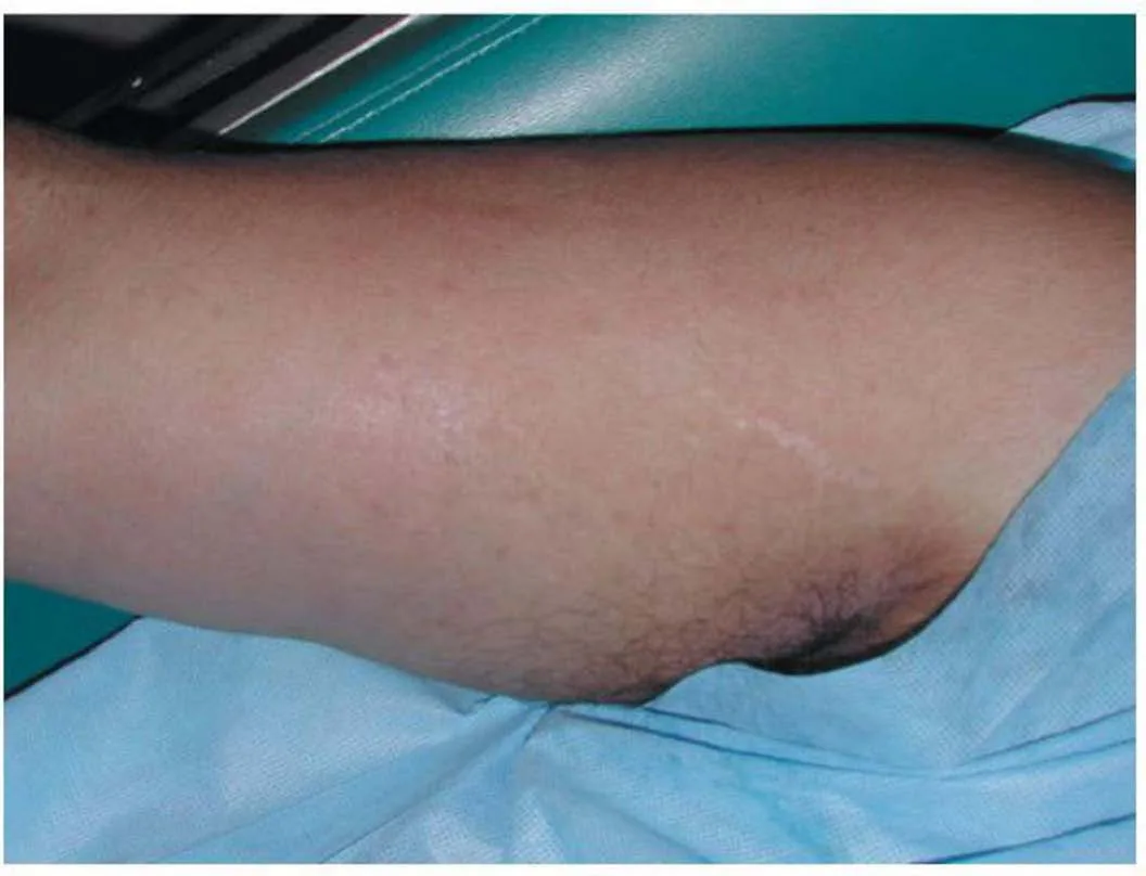 Fig 8. Striae albae (inner arm): established whitish atrophic striae; treatment targets texture and thickness, not colour restoration.