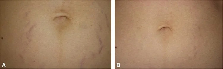 Fig 7. Striae rubrae (abdomen): (A) baseline red-violaceous striae radiating from the umbilicus, the active inflammatory/vascular phase; (B) marked fading after treatment while still in the rubra window.