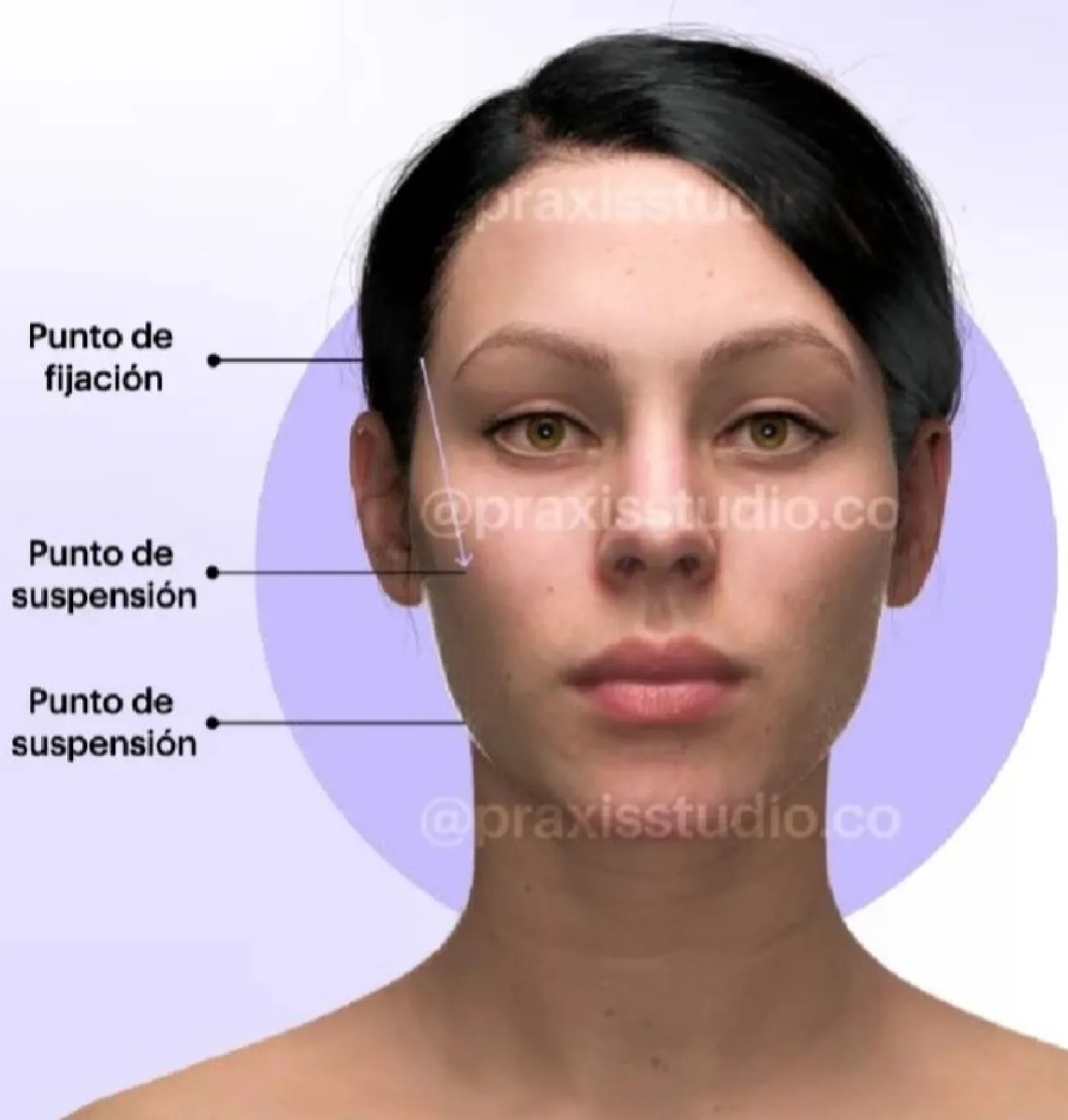 Fig 3. Fixation point at the temporal region and two suspension points along the malar-to-jawline vector.