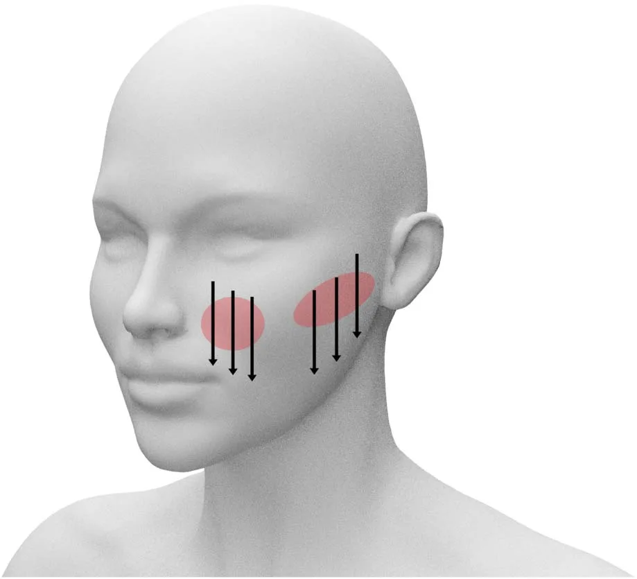 Fig 6. The Kang vertical thread lift: short wedge-shaped PDO sutures inserted vertically downward over the anterior malar and submalar areas (arrows), the vector directly opposing vertical descent.