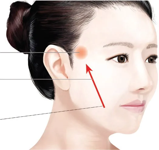 Fig 1. Kim's fixing point, hanging point and direction: the red dot at the zygomatic/temporal region is the fixing point, the arrow the direction, the lower cheek the hanging point.
