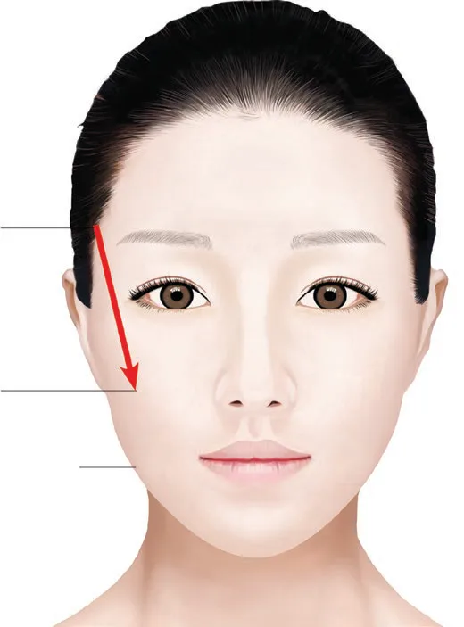 Fig 2. When the hanging point and the part to be pulled do not coincide, the tissue actually elevated is not the target; the vector must connect the true grip point to the fixed point.