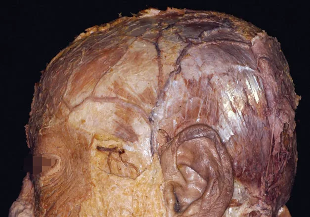 Fig 7. Cadaveric dissection of the temporoparietal region showing the layered superficial fascia (temporoparietal fascia over deep temporal fascia) that anchoring techniques engage and that the temporal branch crosses.