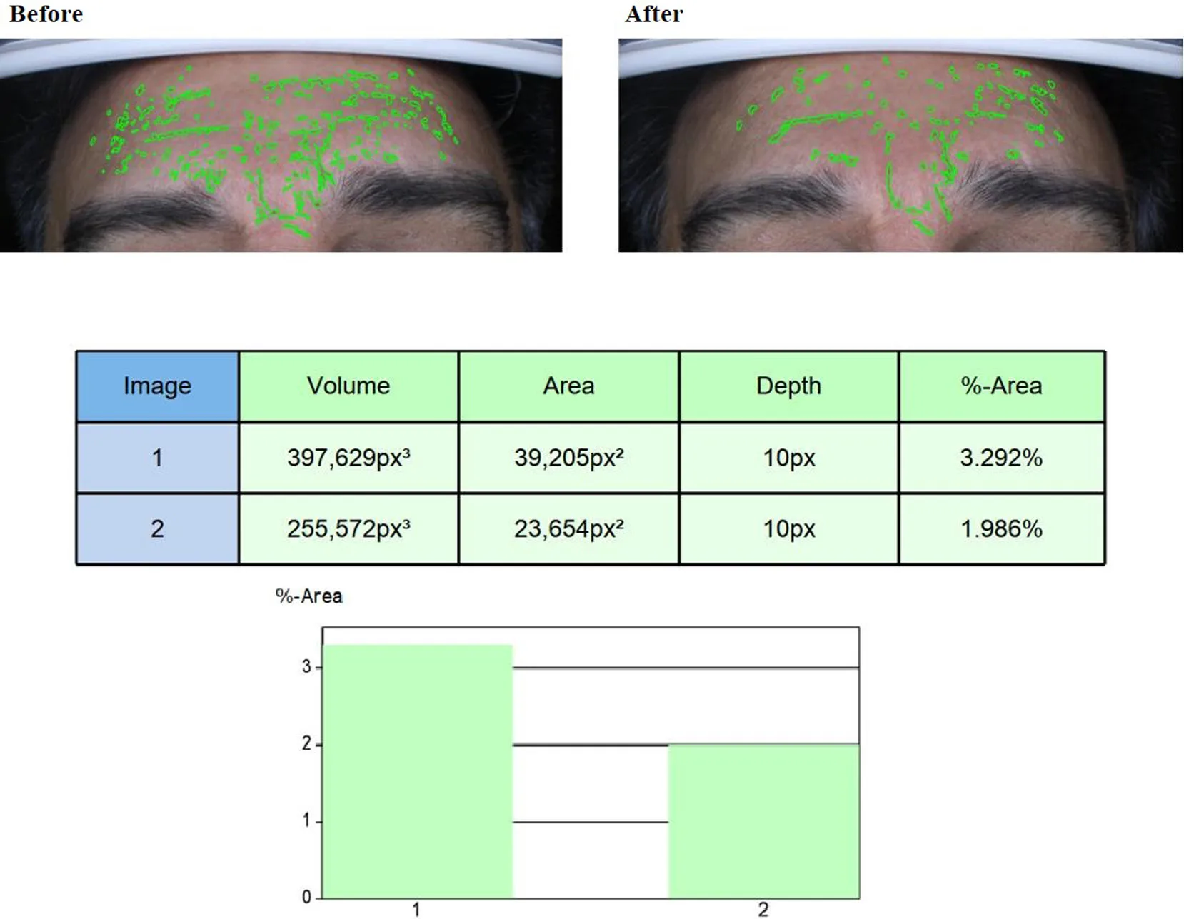 Fig 9. Endolift for forehead wrinkles: before/after skin-topography analysis with the treated %-area falling from 3.292% to 1.986% (depth 10 px), the biometric signature of subdermal collagen remodelling.