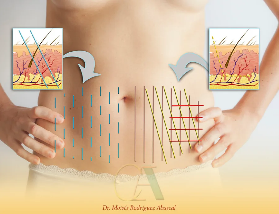 Fig 8. Abdominal tensor-thread design: a vertical field and a crosshatch mesh mapped over the flank and lower abdomen, with insets showing subcutaneous-plane insertion.