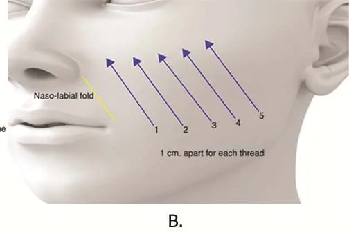 Fig 5. Lower-face short-suture placement: five parallel oblique threads set ~1 cm apart, angled up-and-out toward the fixed zone across the nasolabial-jowl region.