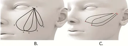 Fig 4. Mid-face lifting vectors: (B) a fan of vectors converging on a single temple entry point; (C) curved/double-needle vectors from the lateral face toward the cheek.