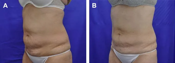 Fig 6. Cryolipolysis outcome: a 42-year-old woman before (A) and 3 months after (B) cryolipolysis, two cycles to the lower abdomen and one to the upper, showing a modest, delayed reduction of the abdominal bulge with weight held stable.