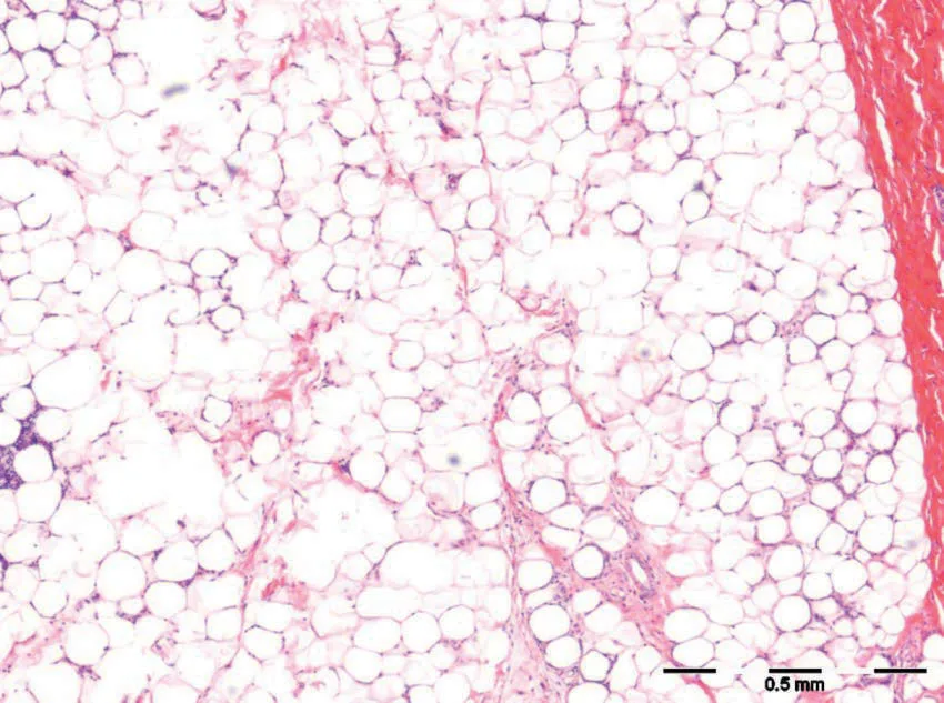 Fig 1. H&E of subcutaneous fat after cryolipolysis: preserved lobular architecture with a mild septal inflammatory infiltrate, the histologic signature of cold panniculitis that precedes adipocyte apoptosis (scale bar 0.5 mm).