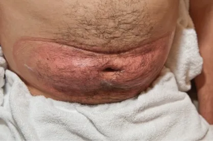 Fig 7. Expected immediate cryolipolysis reaction: the treated abdomen ("muffin top") appears erythematous, swollen and cool to touch after two applications, with the transient outline of the vacuum draw. This is a consented expected effect, not the delayed firm applicator-shaped mass of PAH.