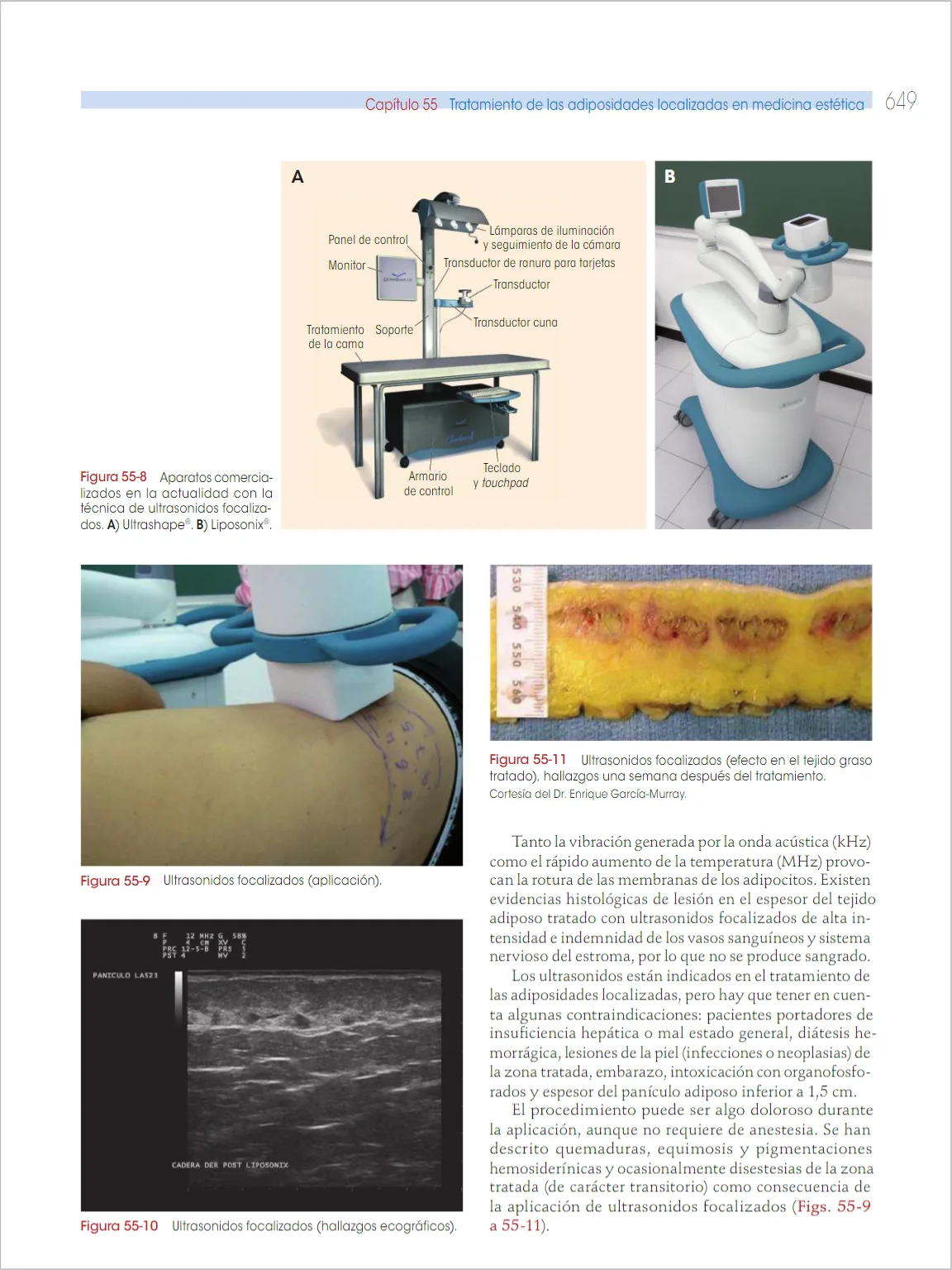 Fig 5. Focused-ultrasound body devices and their tissue effect: (top) UltraShape and Liposonix consoles; (lower) the handpiece marked on the abdomen, the post-Liposonix echographic panniculus, and the treated fat strip with discrete coagulation bands one week out.