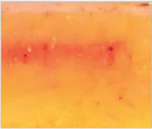 Fig 2. Liposonix tissue effect immediately after treatment (human abdominoplasty specimen): a discrete red band of thermal coagulation at the fixed subdermal focal depth, with the overlying dermis and superficial fat spared.