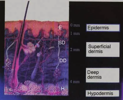 Fig 1. Injection-depth zones referenced throughout this chapter: epidermis (E, 0–1 mm), superficial dermis (SD, ~1–2 mm), deep dermis (DD, ~2–4 mm), hypodermis (H, > 4 mm). Mesotherapy targets < 4 mm to keep the intradermal pharmacokinetics; deeper is a parenteral injection with a different profile.