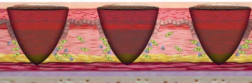 Fig 2. Microneedling creates discrete columnar micro-channels through the epidermis into the dermis; the surrounding cells (fibroblasts and inflammatory cells) mount the growth-factor-driven repair that is the percutaneous collagen-induction mechanism. The epidermis between channels is preserved, which is why the modality spares the melanocyte.