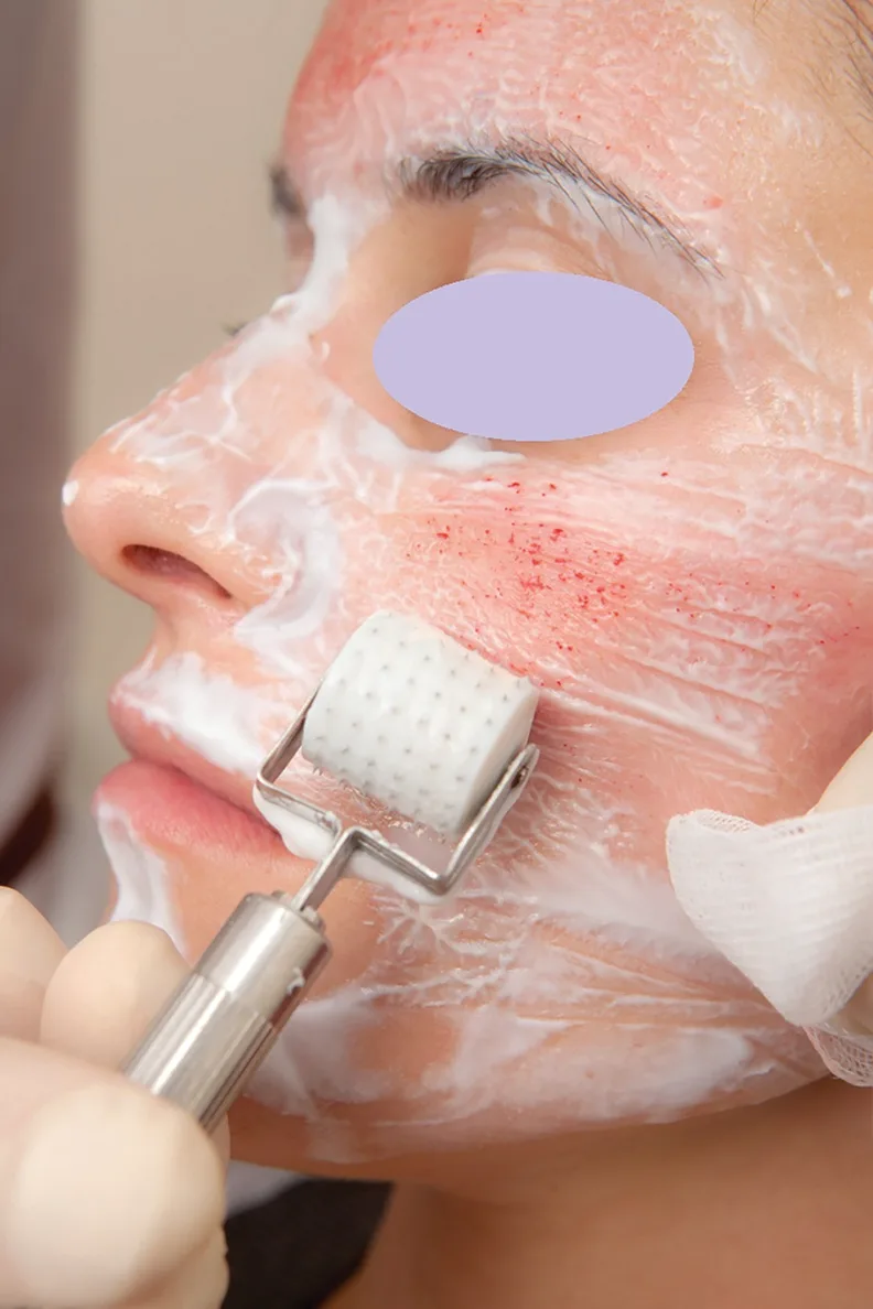 Fig 4. Microneedling pass with uniform pinpoint bleeding across the cheek subunit: this even, punctate haemorrhage is the sign that the dermal target has been reached and the pass should stop. Confluent bleeding or streaking is over-treatment, not more collagen. (Roller shown; the pen produces the same sign with a cleaner channel.)