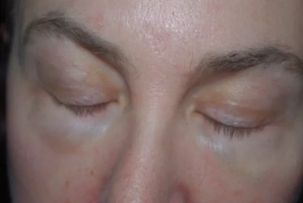 Fig 2. Efecto Tyndall periorbitario bilateral