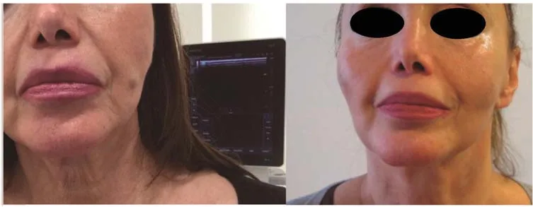 Fig 9. Siliconomas en labios y mejillas, antes y dos meses después de escisión directa