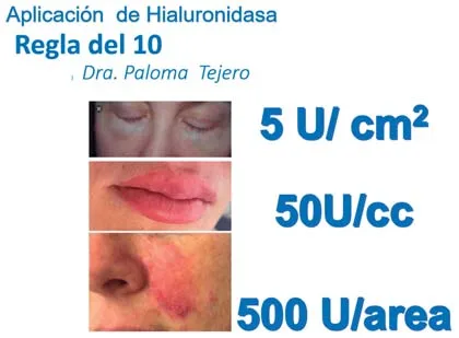 Regla del 10 de la Dra. Tejero: 5 U/cm², 50 U/cc, 500 U/área
