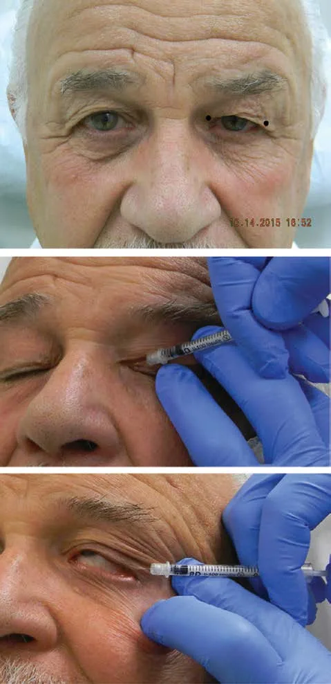 Rescate técnico de la blefaroptosis leve. Arriba, marcado de los dos puntos en los extremos medial y lateral del párpado superior. Centro y abajo, inyección subdérmica con jeringa de insulina en el orbicular pretarsal justo sobre el borde ciliar, primero lateral y luego medial. La dosis total es de 0,5 a 1,5 U: se debilita el depresor del párpado para que el elevador parcialmente paralizado gane recorrido. La porción central no se toca. Benedetto 2018, figura 13.31.