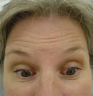 La misma paciente con elevación forzada de las cejas: aparecen las líneas frontales y una ceja sube más que la otra. La maniobra de elevación forzada es lo que convierte una asimetría invisible en un hallazgo documentado antes de cualquier inyección. Benedetto 2018, capítulo 13.