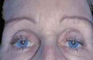 Paciente de 70 años con elevación compensadora de la ceja y una ptosis palpebral izquierda no detectada. Un mes después de la toxina la blefaroptosis se hace visible en reposo. Paciente y médico la atribuyeron al tratamiento hasta comparar con las fotografías previas. Benedetto 2018, figura 13.36.