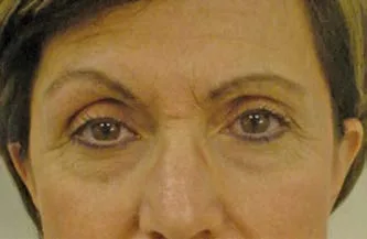 Paciente de 57 años con elevación compensadora de la ceja izquierda. Dos semanas después de onabotulinumtoxinA se aprecia una ligera pseudoblefaroptosis izquierda: la toxina no dañó el elevador, retiró la compensación que lo enmascaraba. Benedetto 2018, figura 13.37.