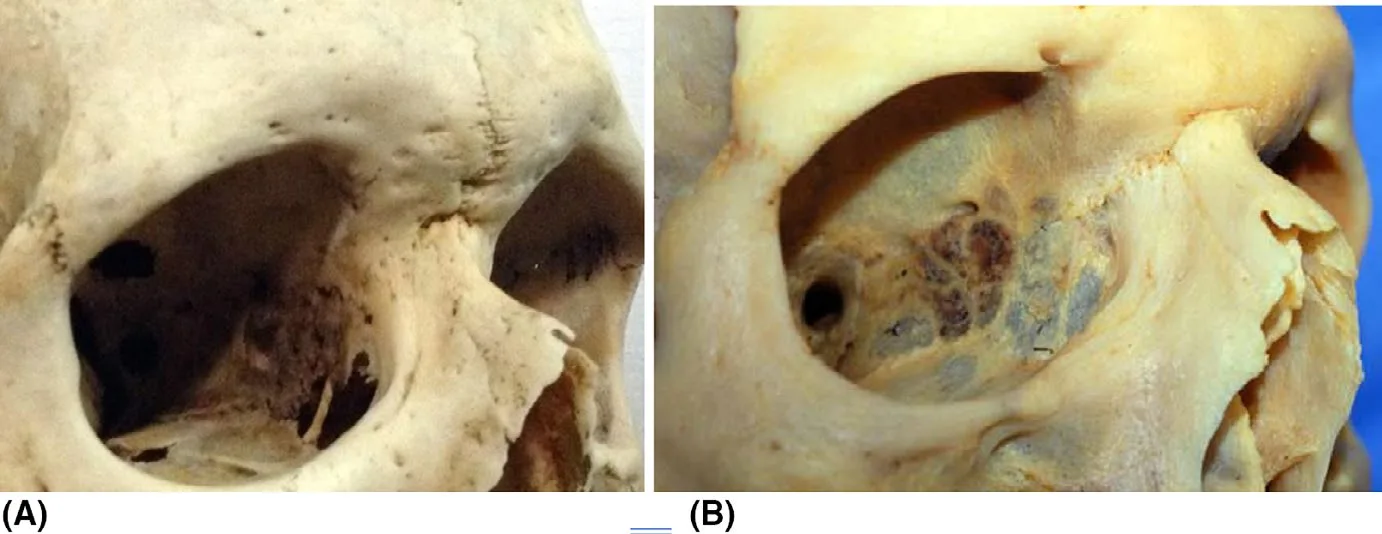 Espécimen craneal, variación anatómica del pedículo supraorbitario: agujero supraorbitario (A) frente a escotadura supraorbitaria (B). El lado con agujero ofrece un atajo hacia el techo de la órbita, y por eso la misma inyección puede producir ptosis en un lado y no en el otro. Nestor 2021, figura 2.