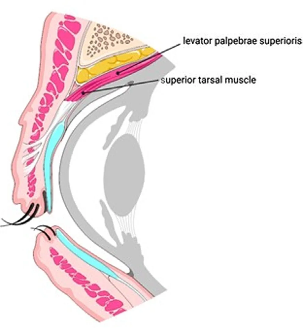Corte sagital del párpado superior con el elevador del párpado superior y, justo por debajo, el músculo tarsal superior (de Müller). El elevador es el que la toxina paraliza; el tarsal superior, simpático y liso, es el que las gotas alfa-adrenérgicas reclutan para recuperar hasta 2,5 mm. Nestor 2021.