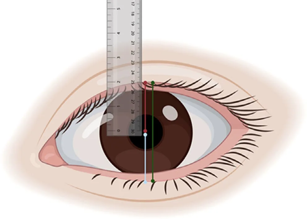 Medición de MRD-1 (rojo), MRD-2 (azul) y fisura palpebral (verde) sobre una regla milimetrada apoyada en la cara. La MRD-1 se mide en posición primaria de la mirada y es la única cifra que convierte «se le ha caído el párpado» en un diagnóstico. Nestor 2021, figura 8.