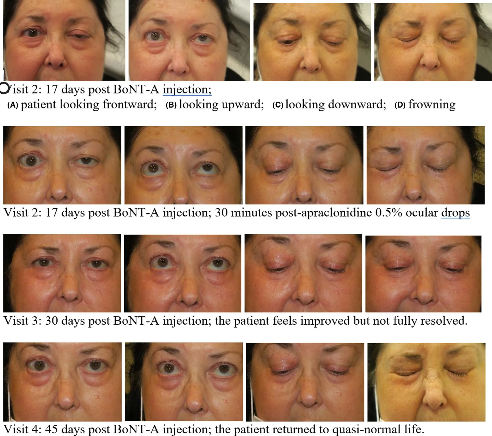 Secuencia completa de una ptosis tras BoNT-A por espasmo hemifacial izquierdo. Fila 1, visita 2 (día 17): mirada al frente, arriba, abajo y con el ceño fruncido. Fila 2: misma visita, 30 minutos después de apraclonidina 0,5 % en colirio, con el párpado visiblemente elevado y la fisura abierta. Fila 3, día 30: mejoría parcial. Fila 4, día 45: recuperación casi completa. Es lo que hay que enseñar al paciente: la gota demuestra la reserva del músculo de Müller, no cura la parálisis. Nestor 2021, figura 10.