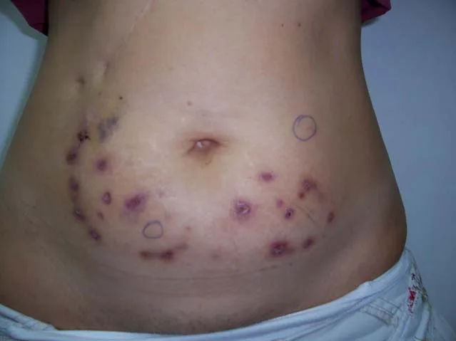 Abdomen de una paciente tras una sesión de mesoterapia: múltiples nódulos y abscesos violáceos dispuestos en arco por los flancos y el hipogastrio, varios con costra o ulceración central, y dos rodeados con marcador para seguimiento. La distribución reproduce punto por punto la pauta de pinchazos, y es ese patrón, y no el aspecto de cada lesión, lo que hace el diagnóstico de micobacteriosis posmesoterapia. Ordiz, Tratado de Mesoterapia, página 132.
