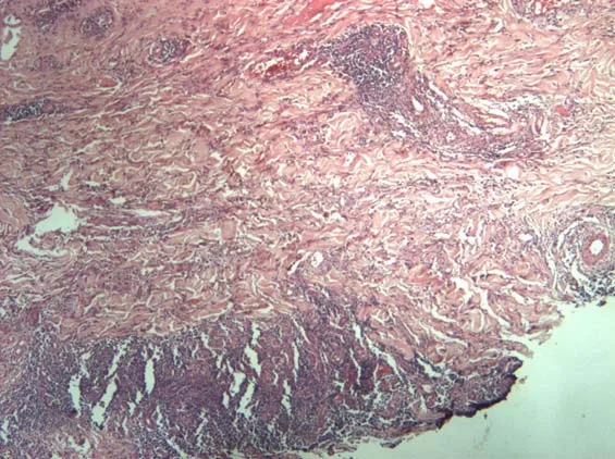 Corte histológico teñido con hematoxilina-eosina de una lesión cutánea posmesoterapia: dermis con haces de colágeno separados por un infiltrado inflamatorio denso y focos de necrosis en la banda inferior. La histología orienta y descarta, pero no identifica la especie: para eso hacen falta el cultivo específico y la técnica molecular de la tabla anterior. Ordiz, Tratado de Mesoterapia, página 133.