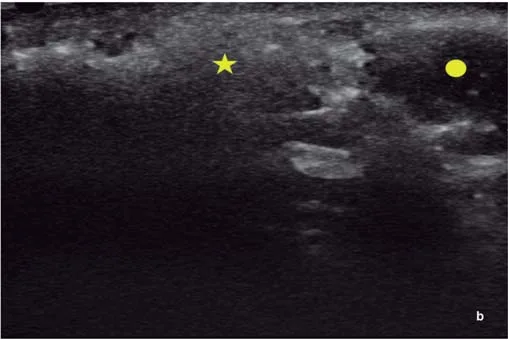 Ecografía de fosa temporal en el mismo caso. Se ven depósitos de material ecogénico granular con una zona más focalizada pseudonodular coincidente con el bultoma palpable, marcada con la estrella, y colecciones de material hipoecoico de contornos lobulados, con ecos internos y refuerzo posterior, marcadas con el círculo. Dos materiales distintos en la misma región y en la misma paciente: el brillante interpretado como PMMA y el oscuro como polialquilamida. Tejero 2024, diapositiva 386.