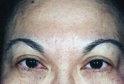 Frente y región periorbitaria de una paciente después de un tratamiento combinado de toxina botulínica y relleno: la piel glabelar aparece lisa, sin líneas estáticas residuales visibles en reposo, y la posición y el arco de ambas cejas son simétricos. Es el fotograma posterior de un caso combinado; la imagen previa no acompaña a esta lámina en el corpus, de modo que documenta el aspecto obtenido y no la magnitud del cambio. Benedetto, Botulinum Toxins in Clinical Aesthetic Practice, figura 7.1.
