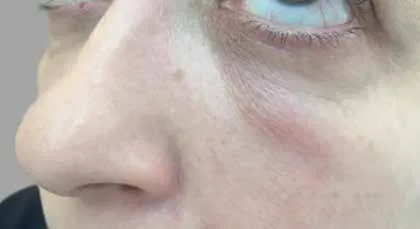 Fig 4. Delayed intermittent/persistent malar and infraorbital edema (ETIP) at a tear-trough HA filler site: the clinical phenotype is soft, non-fluctuant, non-purulent swelling with faint overlying erythema, distinct from the tender, warm, fluctuant mass of infection.