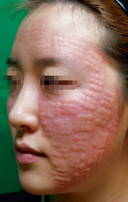 Fig 6. Hyaluronic-acid filler hypersensitivity presenting as a grid of erythematous, oedematous papules following an intradermal (skinbooster/mesotherapy) injection pattern: the geometric distribution mirrors the injection template, a clue that the reaction is to the injected material rather than a spontaneous dermatosis.