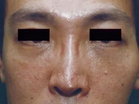 Fig 7. Bilateral, symmetric infraorbital swelling and nodularity at tear-trough HA filler sites: a delayed inflammatory/hypersensitivity phenotype (soft, non-purulent) that must still be separated from infection and from simple product malposition by history, timing and ultrasound.